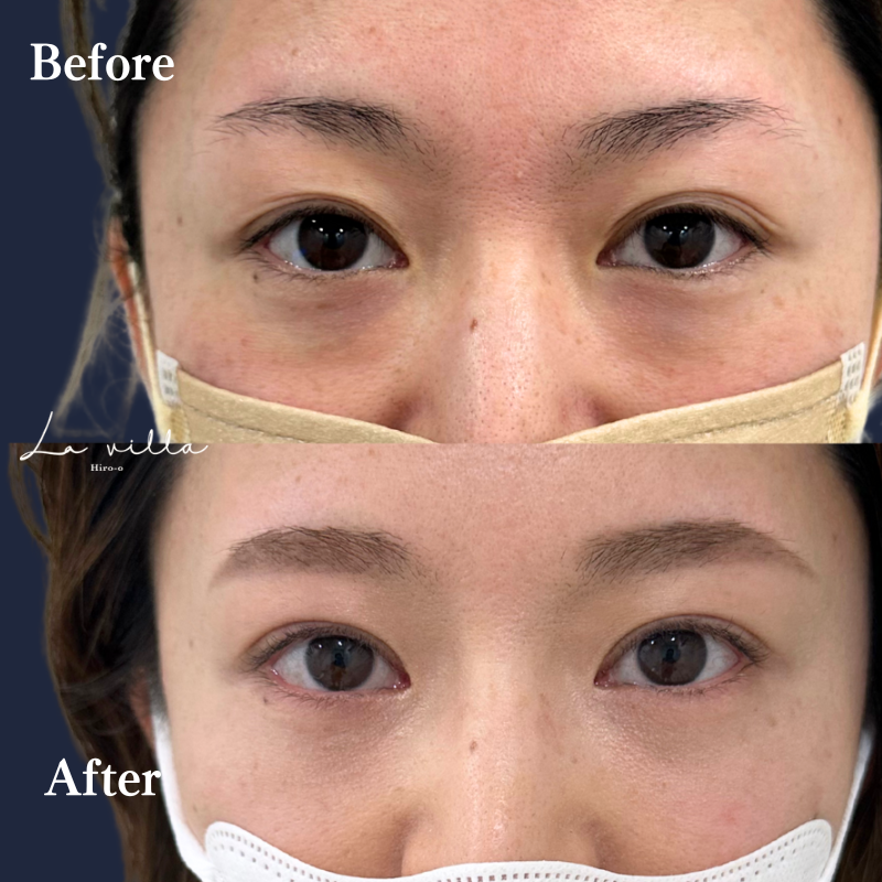 裏ハムラ＋二重埋没 No.278