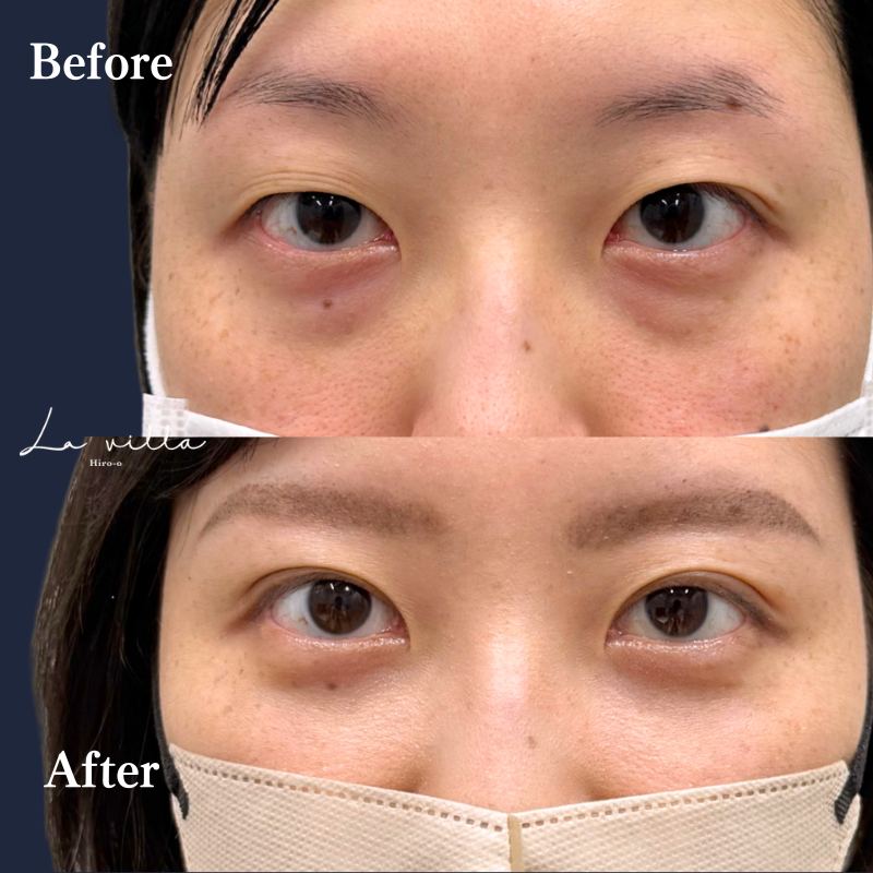 裏ハムラ＋二重埋没 No.279