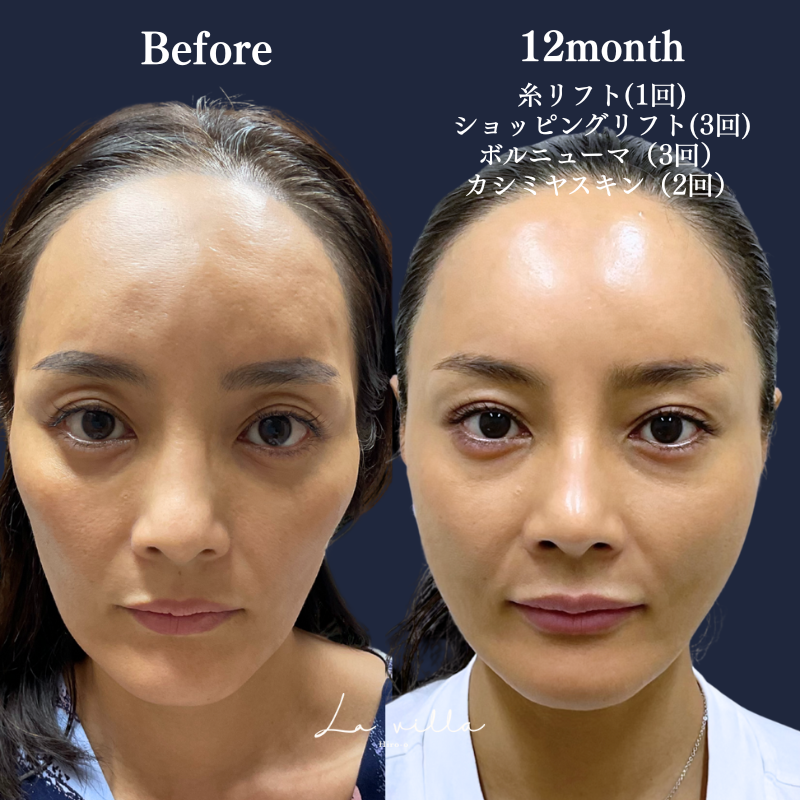 カシミヤスキン＋糸リフト＋ショッピングリフト＋ボルニューマ　No.271