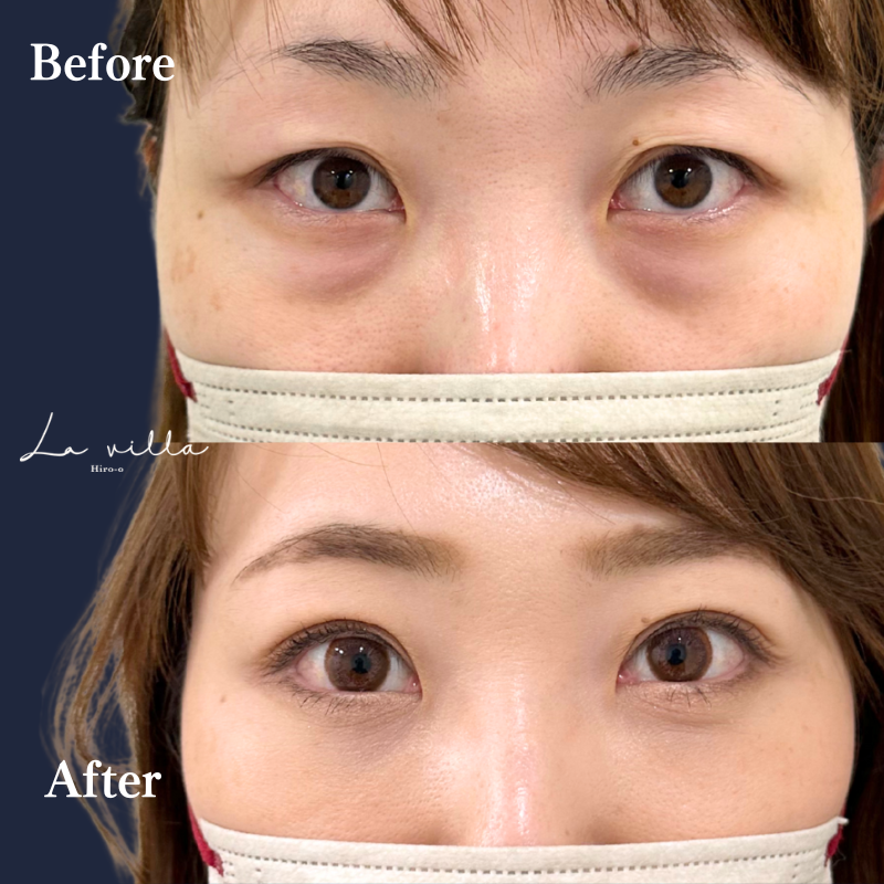 裏ハムラ＋二重埋没 No.280