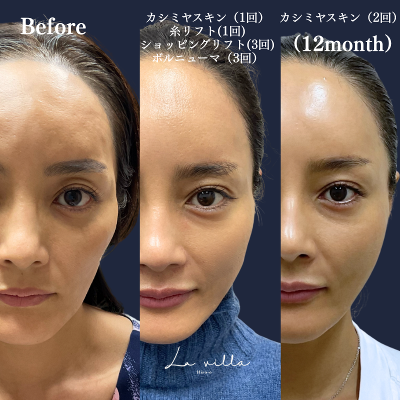 カシミヤスキン＋糸リフト＋ショッピングリフト＋ボルニューマ　No.271