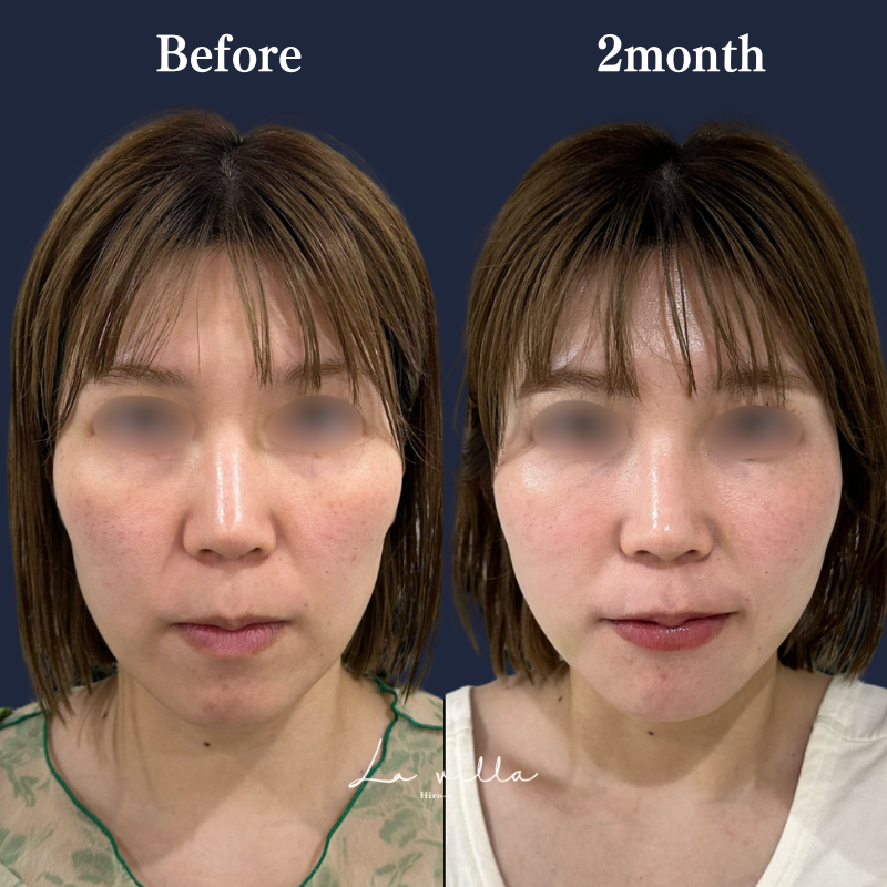 糸リフト＋ショッピングリフト No.240