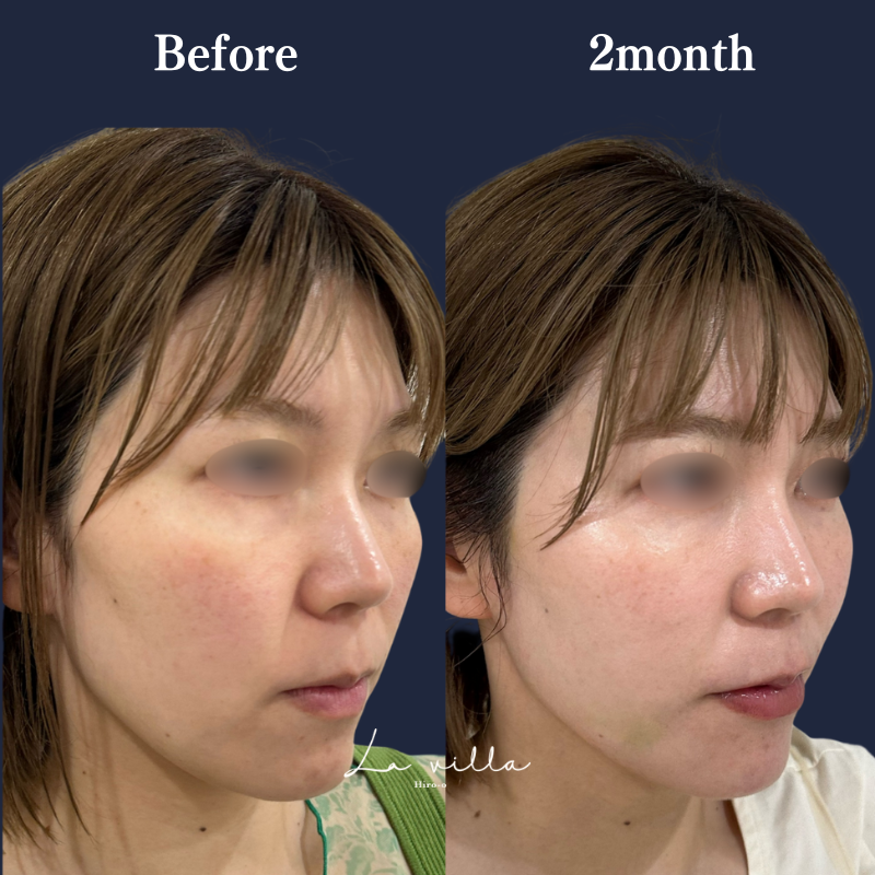 糸リフト＋ショッピングリフト No.240