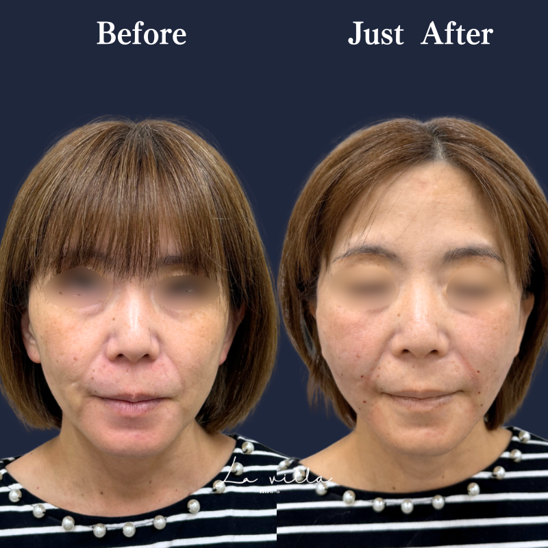 糸リフト＋ショッピングリフト No.241