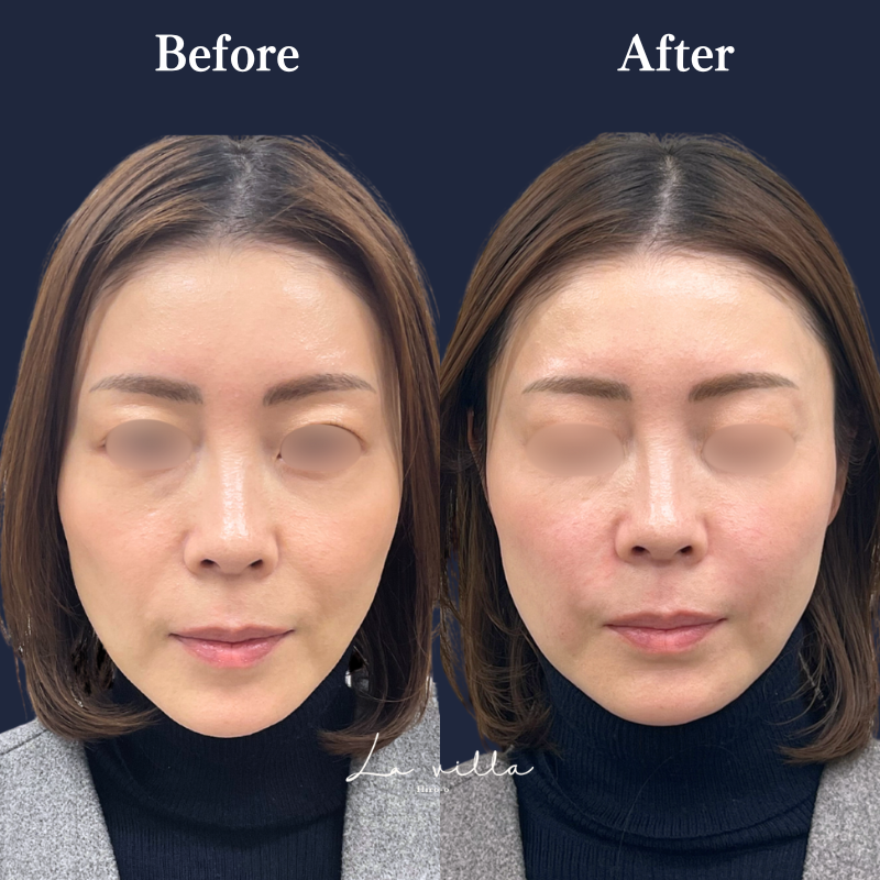 ほうれい線ヒアルロン酸  No.247