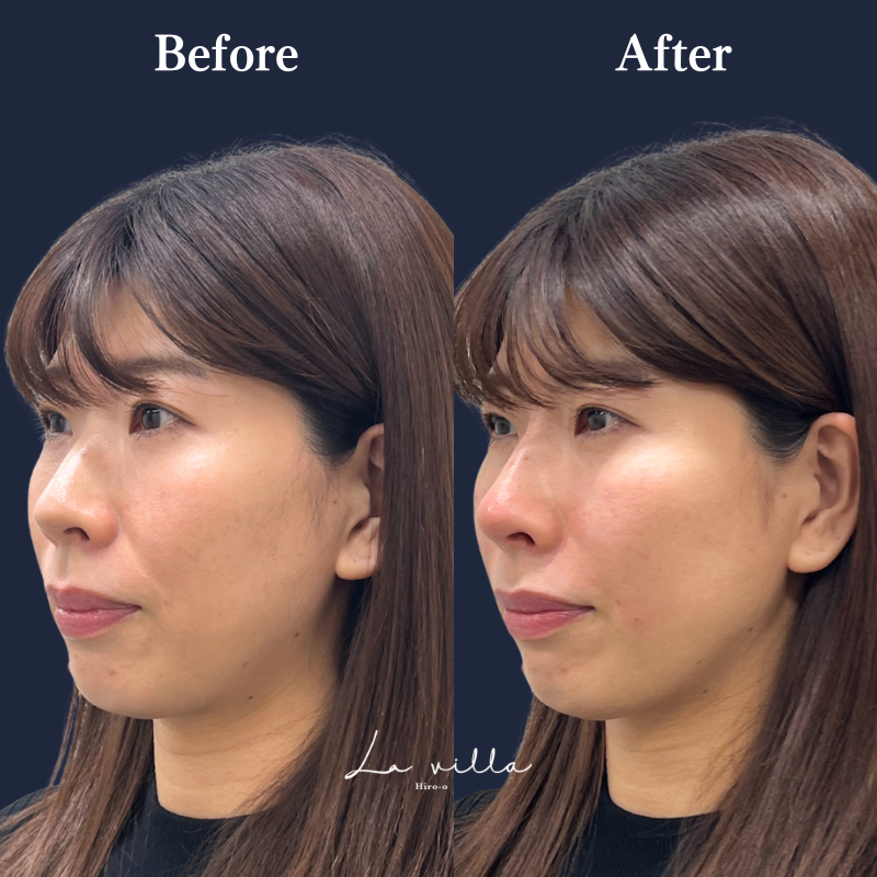 ほうれい線＋鼻ヒアルロン酸 No.248