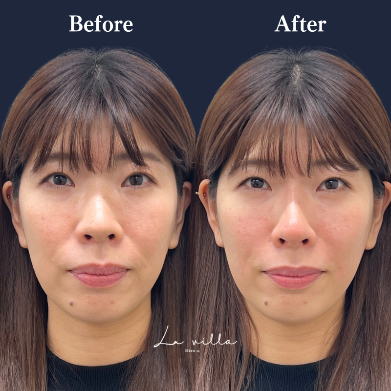 ほうれい線＋鼻ヒアルロン酸 No.248