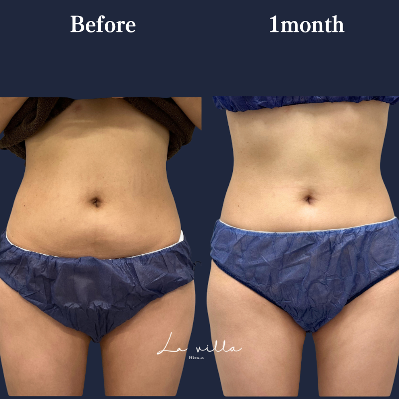 リヴァイブ（お腹） No.257