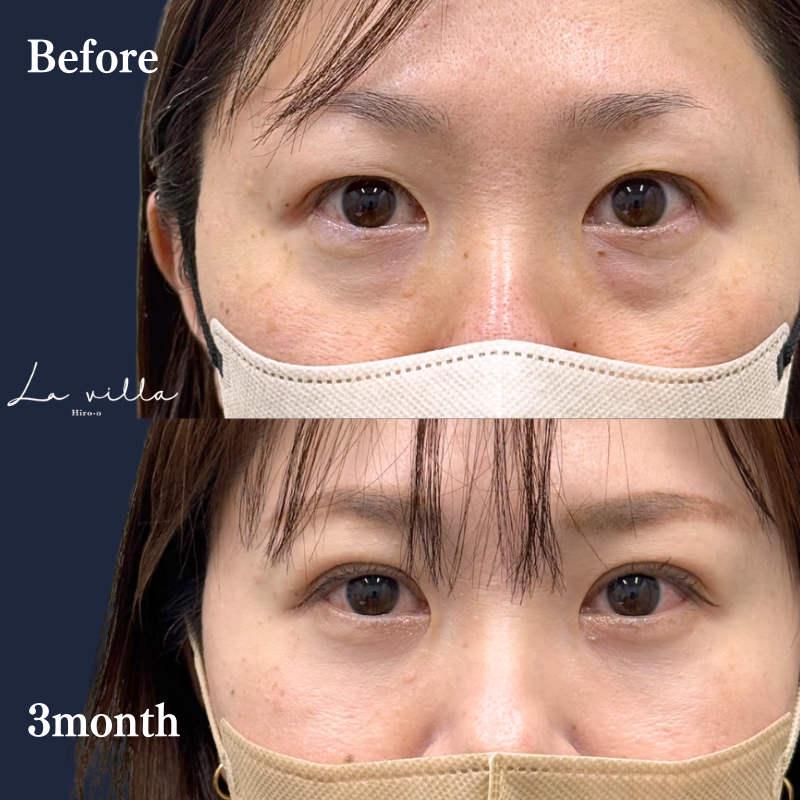 裏ハムラ＋二重埋没 No.258