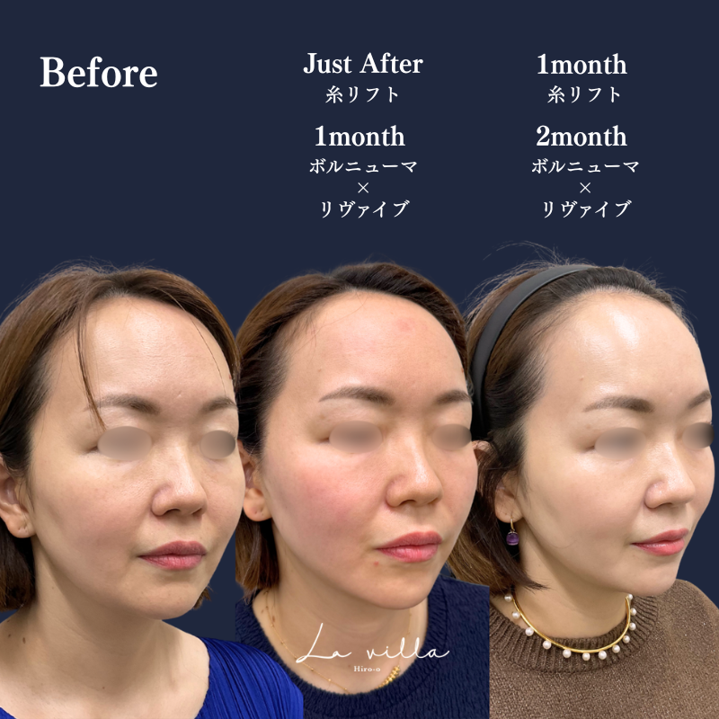 糸リフト＋ショッピングリフト＋ボルニューマ×リヴァイブ No.282