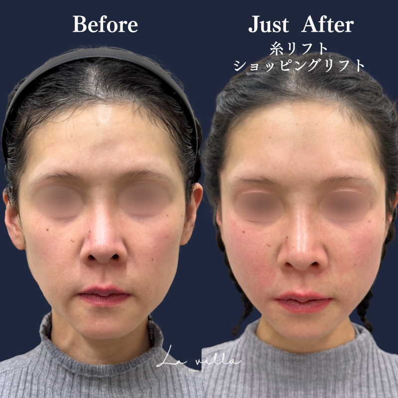 糸リフト＋ショッピングリフト No.274