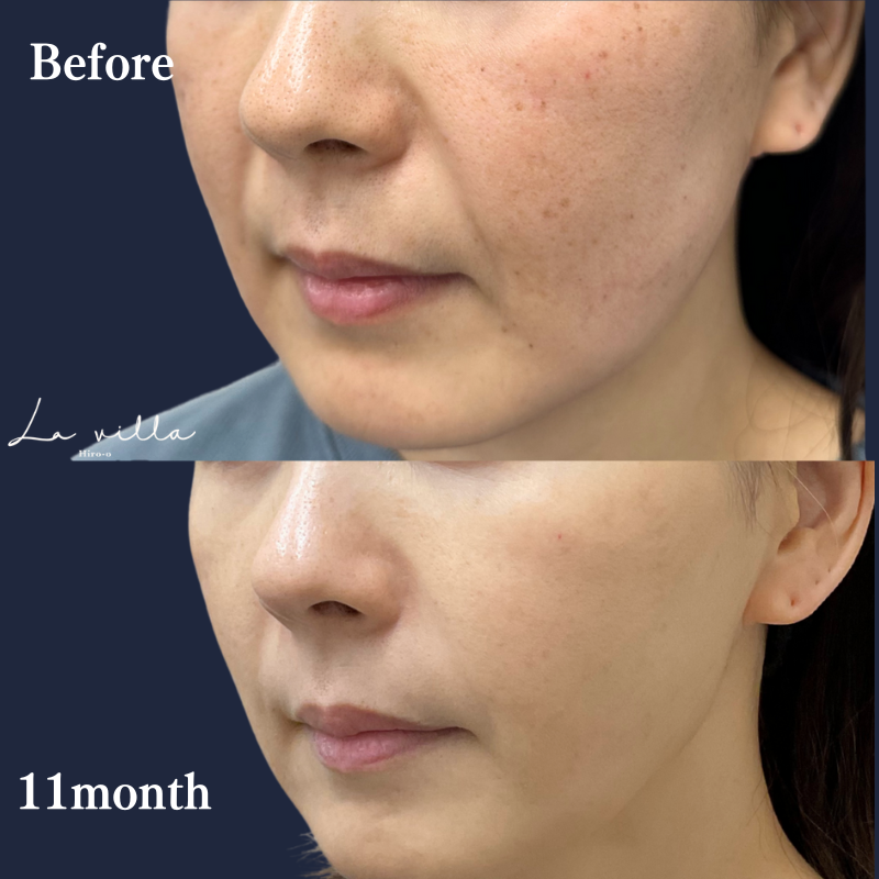 フォトフェイシャル（ステラM22）＋プルリアルデンシファイ No.265