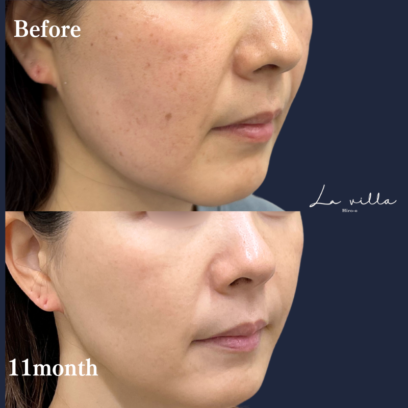 フォトフェイシャル（ステラM22）＋プルリアルデンシファイ No.265