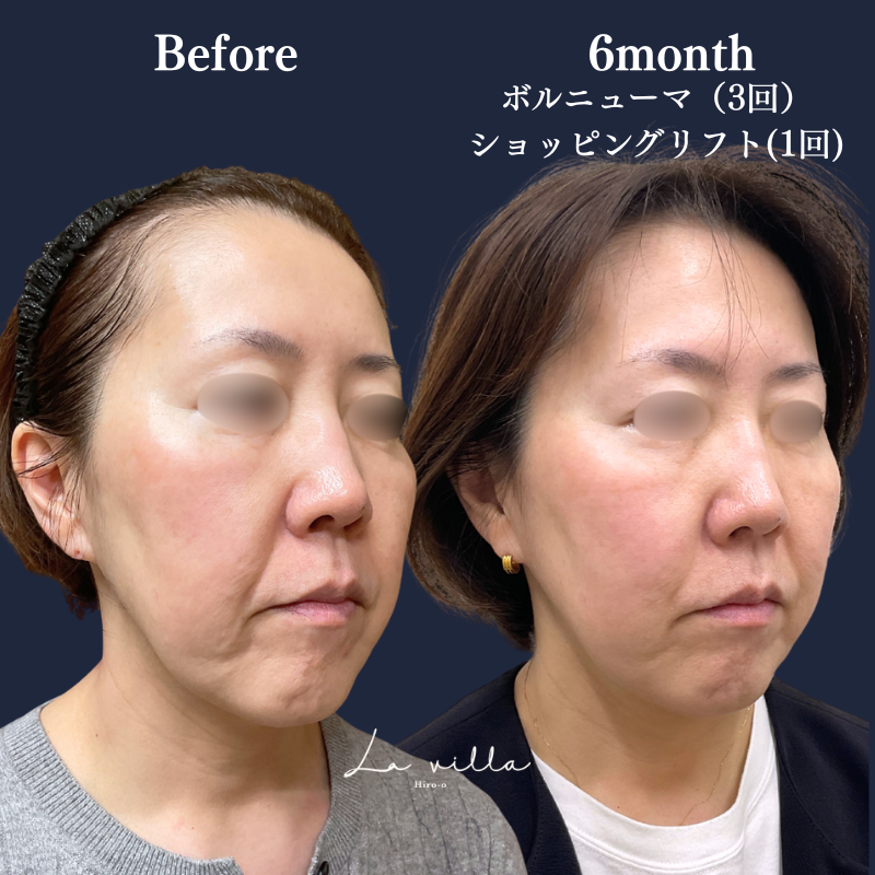 ボルニューマ＋ショッピングリフト No.266