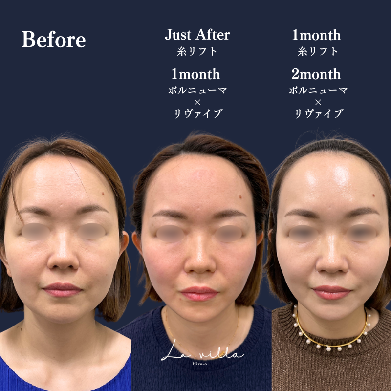 糸リフト＋ショッピングリフト＋ボルニューマ×リヴァイブ No.282