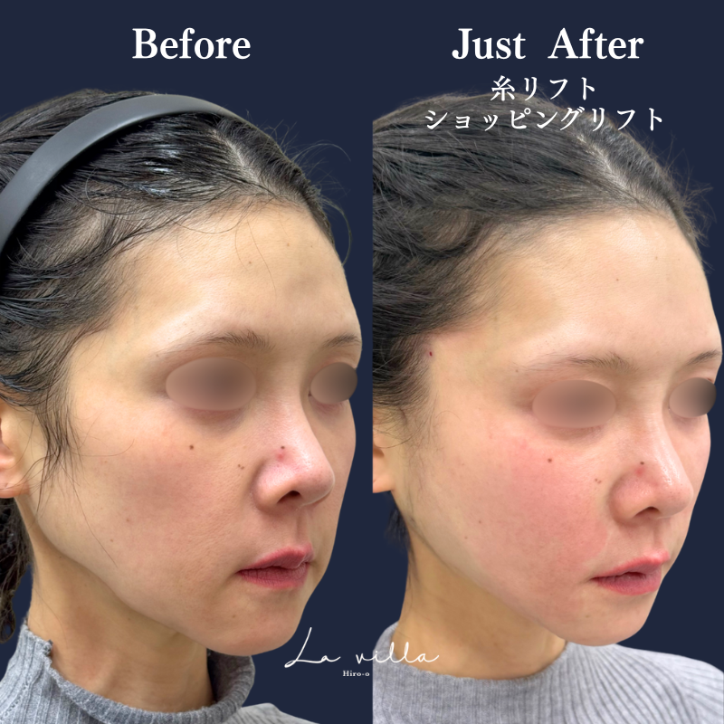 糸リフト＋ショッピングリフト No.274