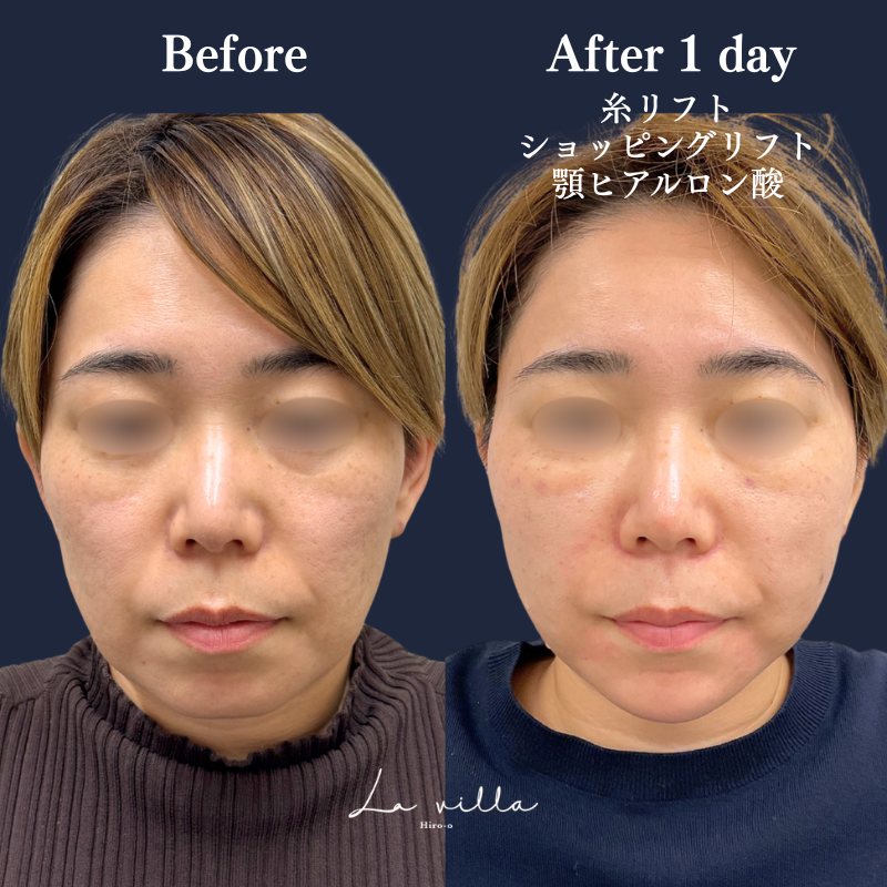糸リフト＋ショッピングリフト＋顎ヒアルロン酸 No.275