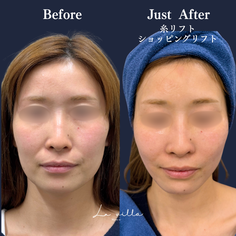 糸リフト＋ショッピングリフト No.276