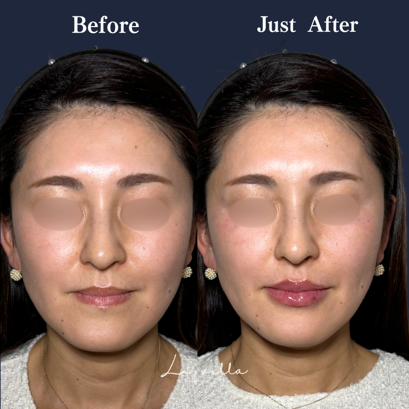 唇ヒアルロン酸  No.286