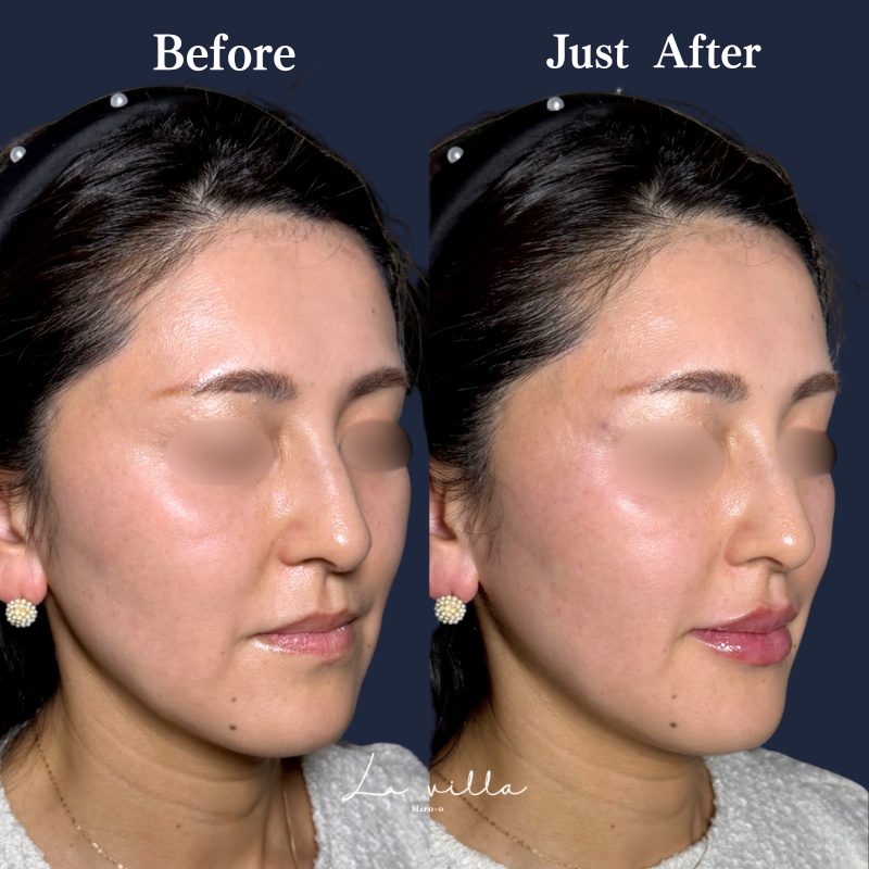 唇ヒアルロン酸  No.286