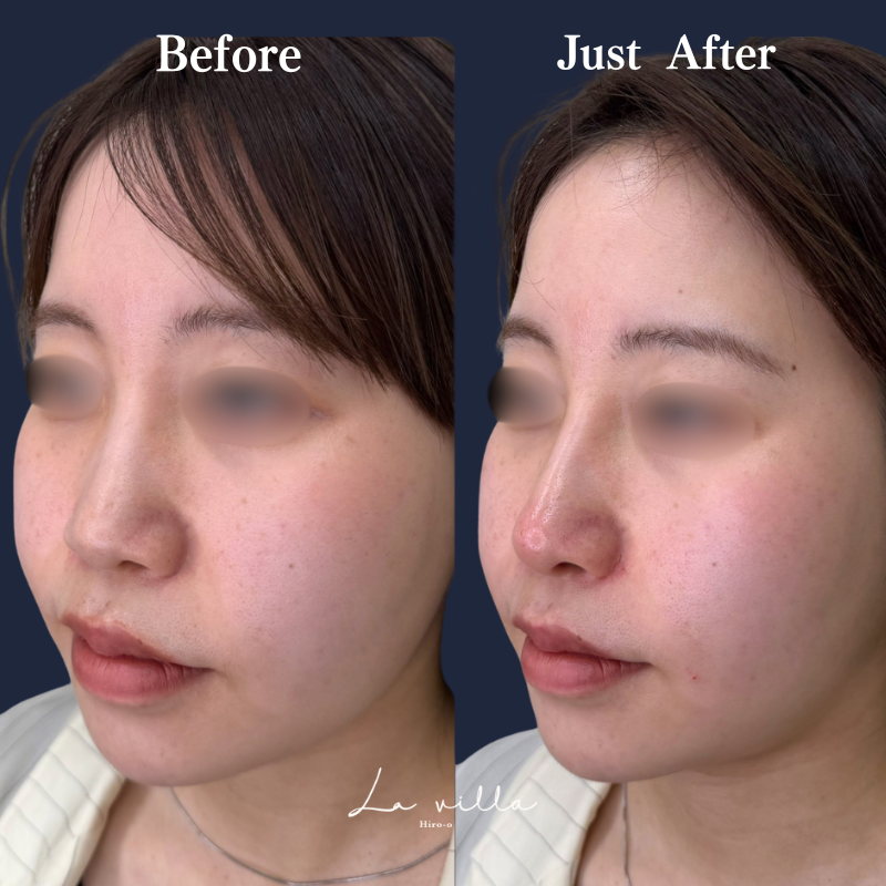 鼻ヒアルロン酸 No.287