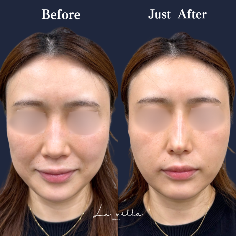 鼻ヒアルロン酸 No.288