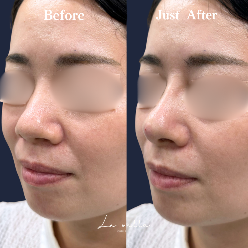 鼻ヒアルロン酸 No.289