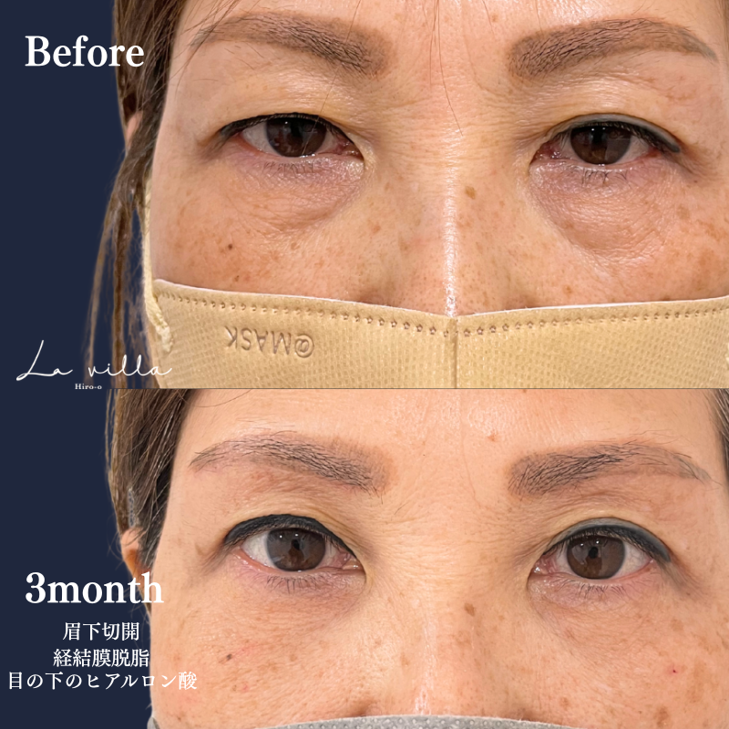 眉下切開+経結膜脱脂+目の下ヒアルロン酸　 No.298