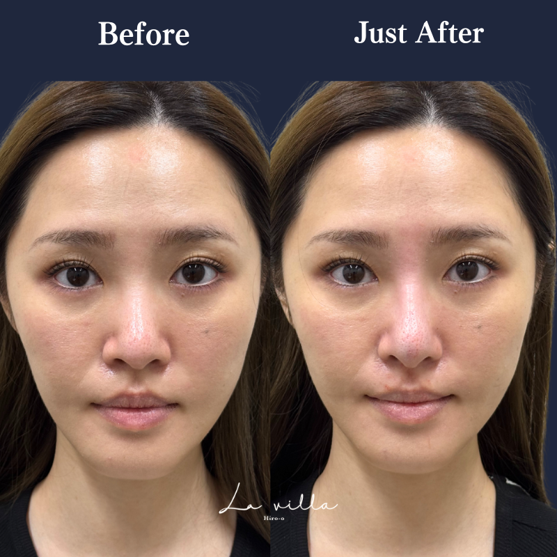 鼻ヒアルロン酸 No.292