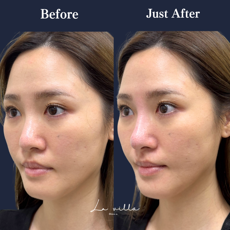 鼻ヒアルロン酸 No.292