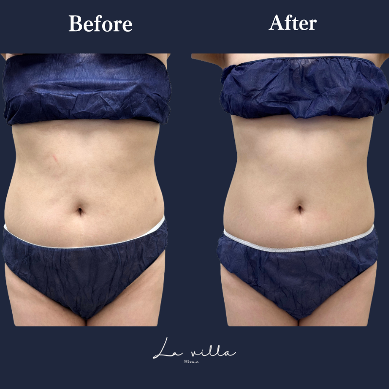 リヴァイブ（お腹） No.309