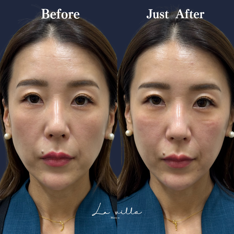 スーパーハイフRT No.323