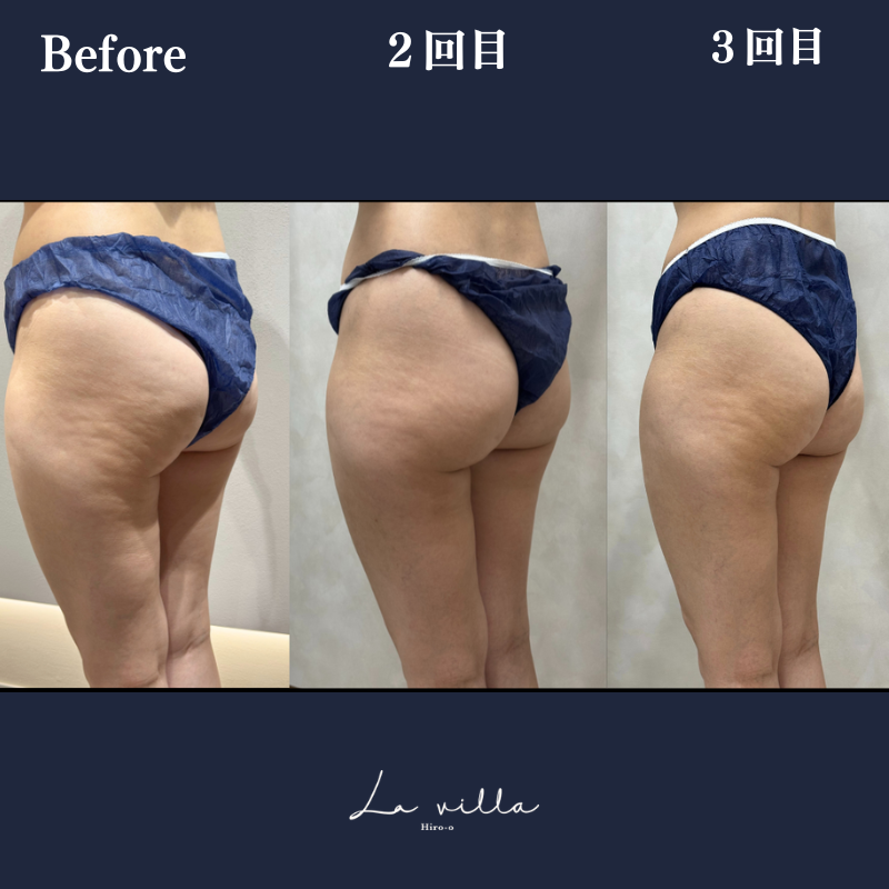 リヴァイブ(ヒップ)No.310