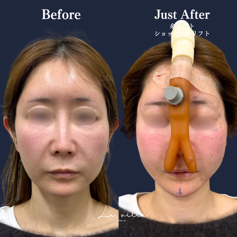 糸リフト＋ショッピングリフト No.311