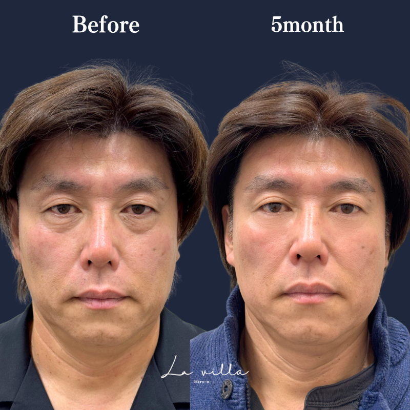 表ハムラ　No.325