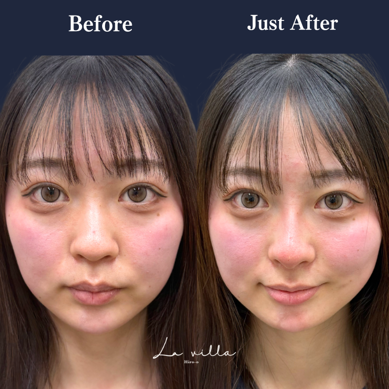 鼻ヒアルロン酸 No.313