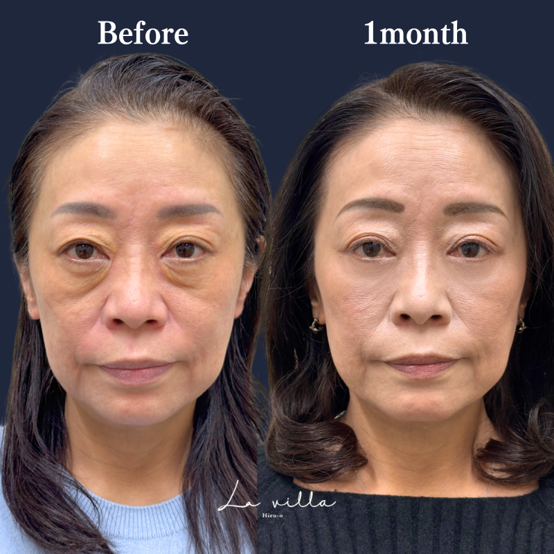 表ハムラ　No.326