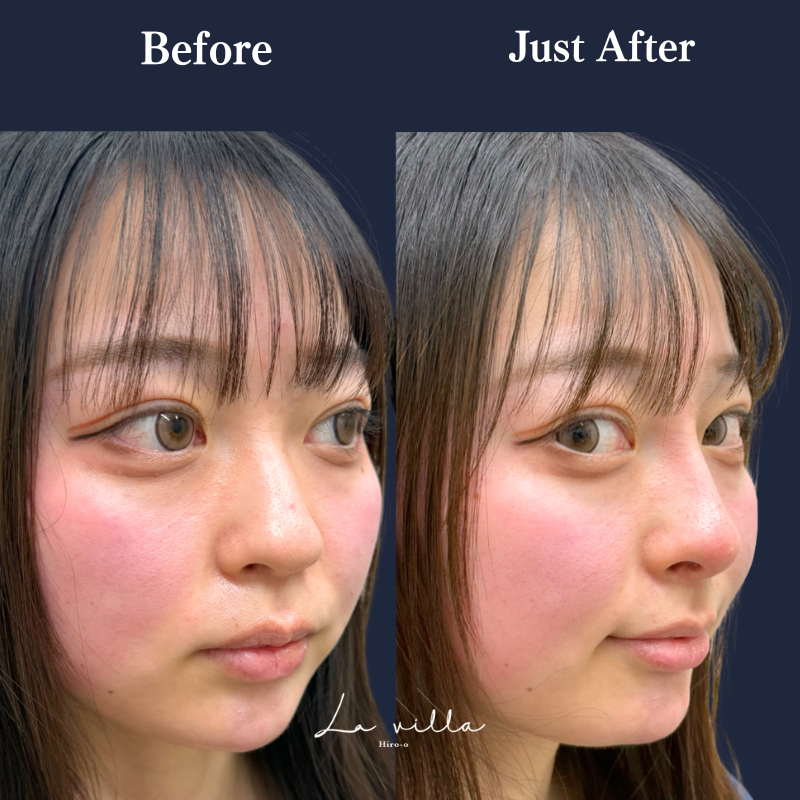 鼻ヒアルロン酸 No.313