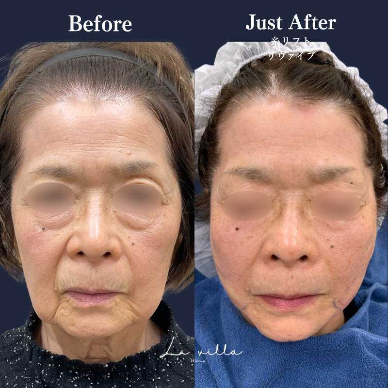 糸リフト＋リヴァイブ　No.291