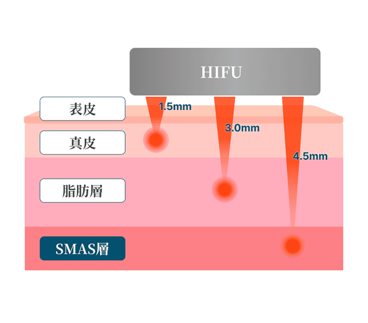 HIFU治療の仕組み