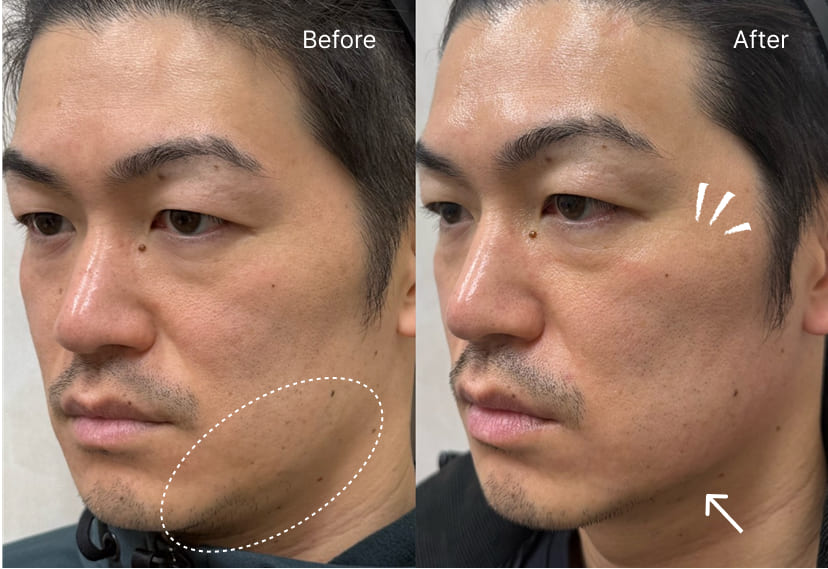 皮膚のタイトニング、リフトアップ効果