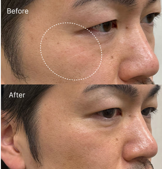 目周りの小皺改善