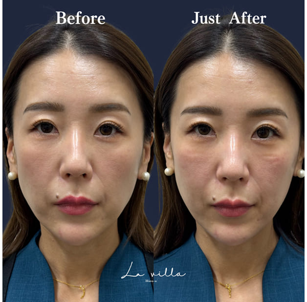 CASE 02 Before / Just After