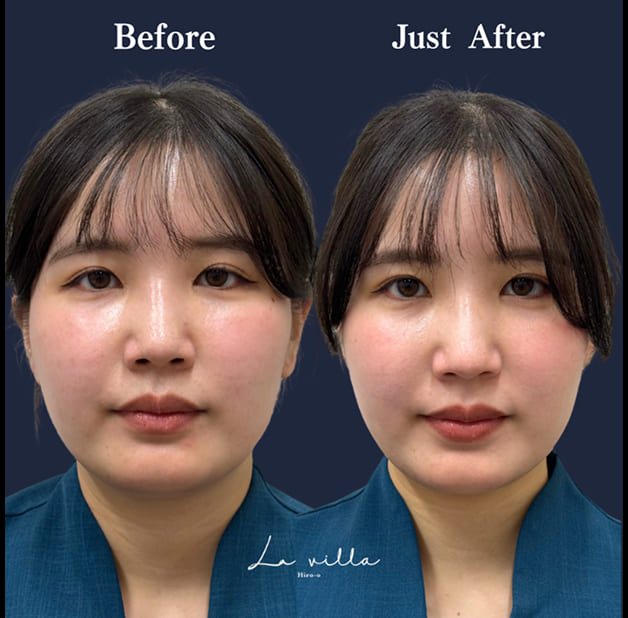 CASE 03 Before / Just After