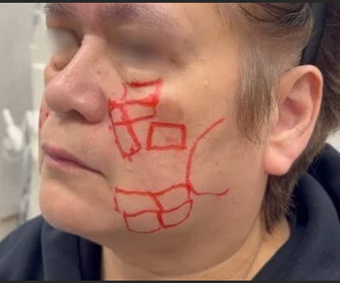 照射前のデザイン