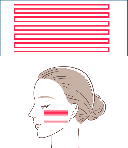 11列×往復リニア照射