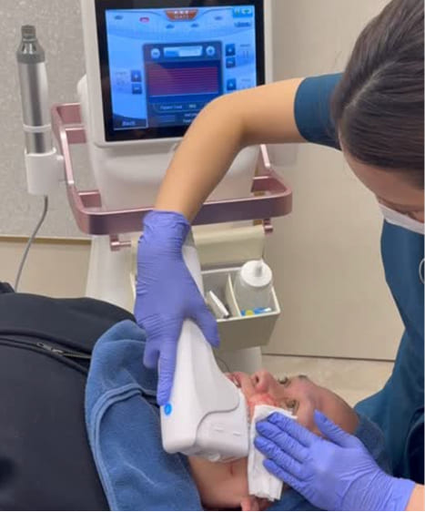 チークトップにボリュームを持たせる照射方法