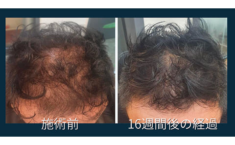 薄毛治療