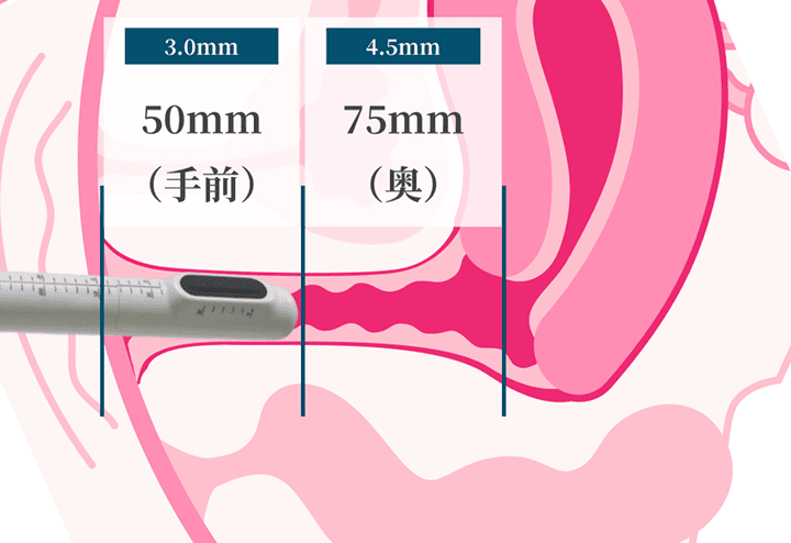 カートリッジ照射範囲