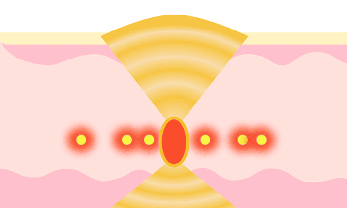 従来のハイフ照射